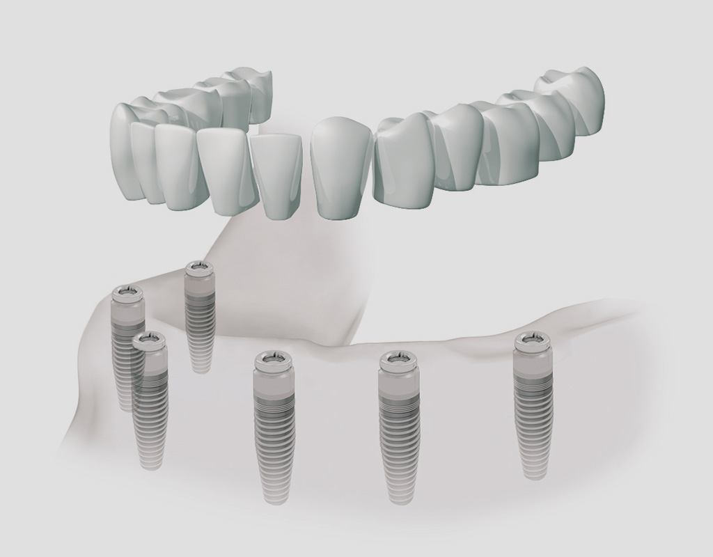 Dentaduras completas fijas en Burgos