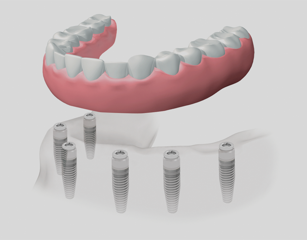 Dentadura completa híbrida