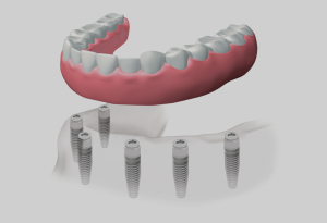 Dentadura completa híbrida