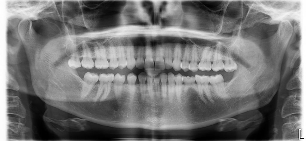 Agenesia dental: ¿Qué es? ¿Tiene solución?